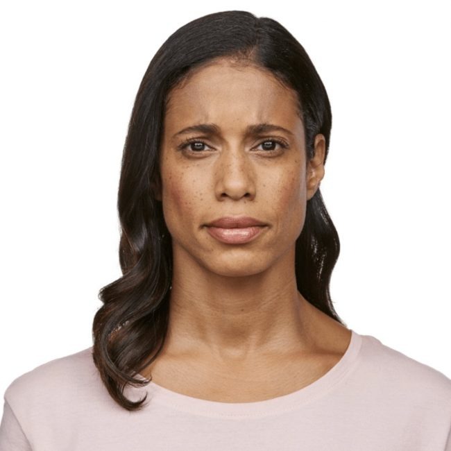 Wrinkle Relaxers Before and After - Case -1, Image 2 - Female, age 35 – 44 - East Moriches, NY - MD365 Aesthetics