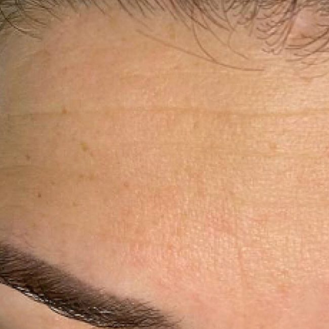 Chemical Peel Before and After - Case 2, Image 2 - Female, age 45 – 54 - East Moriches, NY - MD365 Aesthetics