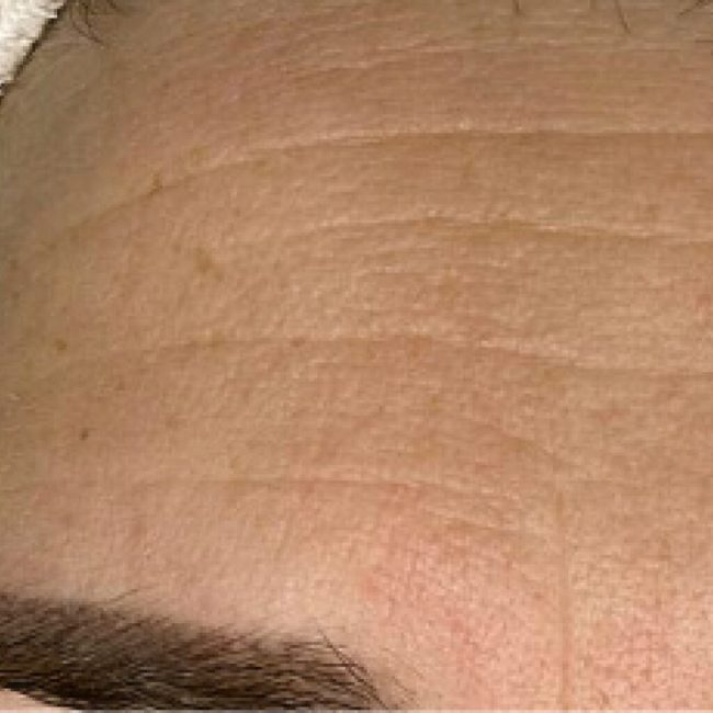 Chemical Peel Before and After - Case 2, Image 1 - Female, age 45 – 54 - East Moriches, NY - MD365 Aesthetics