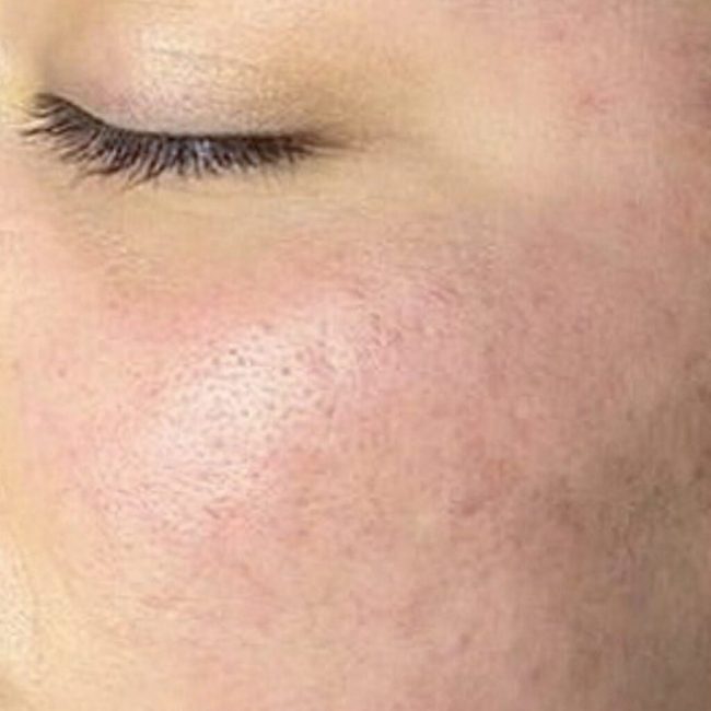 Chemical Peel Before and After - Case -1, Image 2 - Female, age 25 – 34 - East Moriches, NY - MD365 Aesthetics