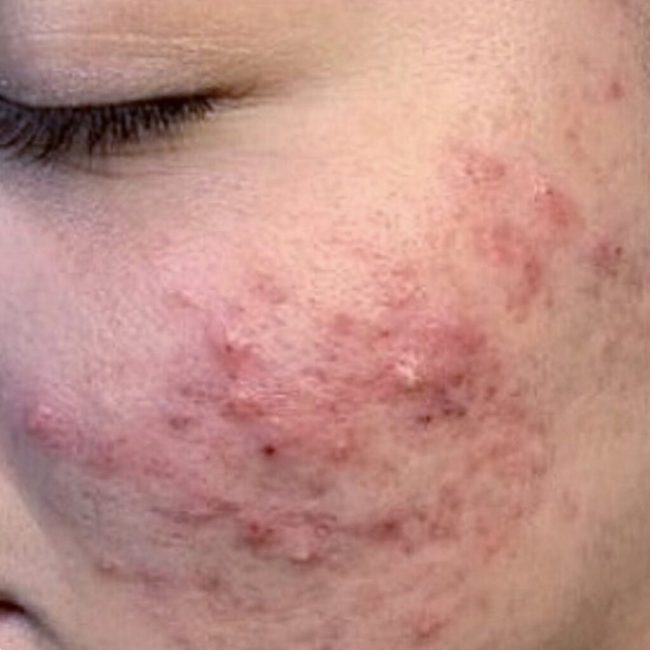 Chemical Peel Before and After - Case -1, Image 1 - Female, age 25 – 34 - East Moriches, NY - MD365 Aesthetics