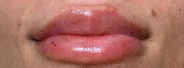 Dermal Fillers Before and After - Case 8, Image 2 - Female, age 25 – 34 - East Moriches, NY - MD365 Aesthetics