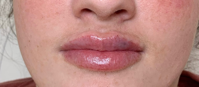 Dermal Fillers Before and After - Case 10, Image 2 - Female, age 25 – 34 - East Moriches, NY - MD365 Aesthetics