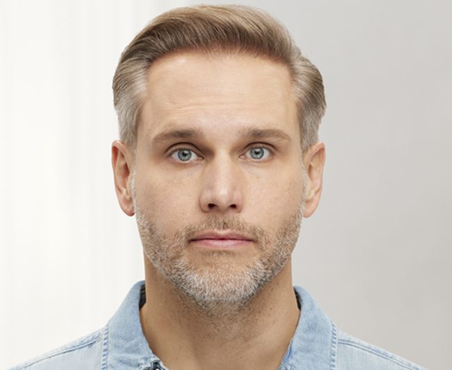 Wrinkle Relaxers Before and After - Case 3, Image 6 - Male, age 35 – 44 - East Moriches, NY - MD365 Aesthetics