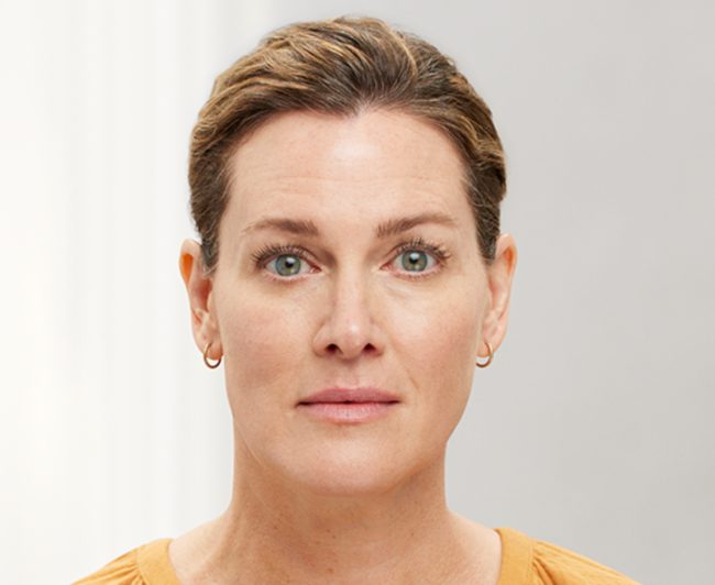 Wrinkle Relaxers Before and After - Case 5, Image 4 - Female, age 45 – 54 - East Moriches, NY - MD365 Aesthetics
