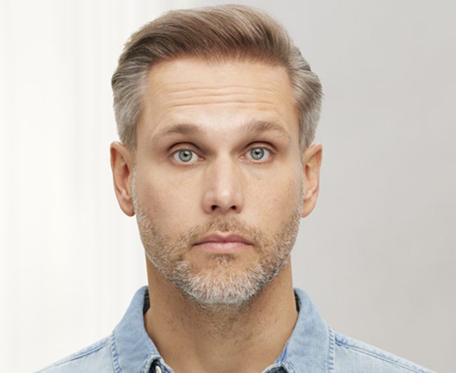 Wrinkle Relaxers Before and After - Case 3, Image 5 - Male, age 35 – 44 - East Moriches, NY - MD365 Aesthetics