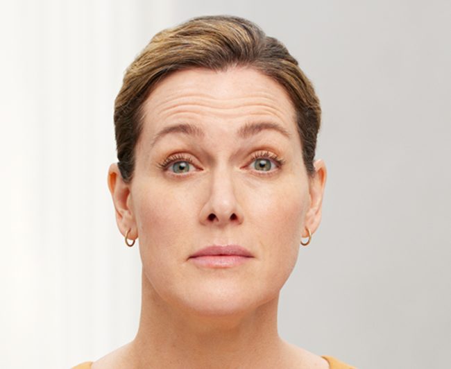 Wrinkle Relaxers Before and After - Case 5, Image 3 - Female, age 45 – 54 - East Moriches, NY - MD365 Aesthetics