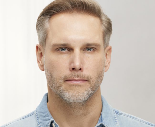 Wrinkle Relaxers Before and After - Case 3, Image 2 - Male, age 35 – 44 - East Moriches, NY - MD365 Aesthetics