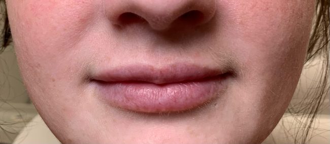 Dermal Fillers Before and After - Case 10, Image 1 - Female, age 25 – 34 - East Moriches, NY - MD365 Aesthetics