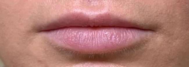 Dermal Fillers Before and After - Case 9, Image 1 - Female, age 25 – 34 - East Moriches, NY - MD365 Aesthetics