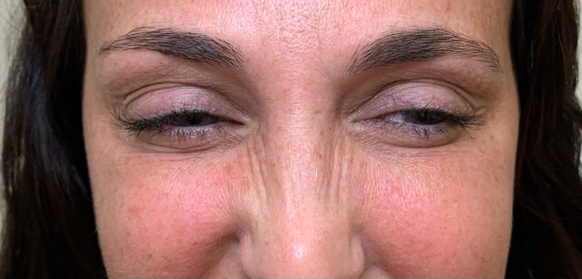Wrinkle Relaxers Before and After - Case 6, Image 2 - Female, age 35 – 44 - East Moriches, NY - MD365 Aesthetics