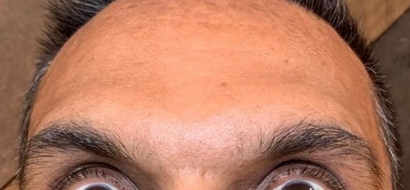 Wrinkle Relaxers Before and After - Case 8, Image 2 - Male, age 35 – 44 - East Moriches, NY - MD365 Aesthetics