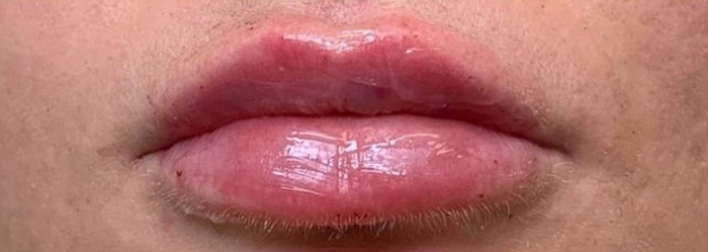 Dermal Fillers Before and After - Case 9, Image 2 - Female, age 25 – 34 - East Moriches, NY - MD365 Aesthetics