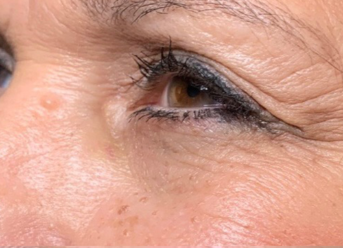 Wrinkle Relaxers Before and After - Case 7, Image 2 - Female, age 45 – 54 - East Moriches, NY - MD365 Aesthetics