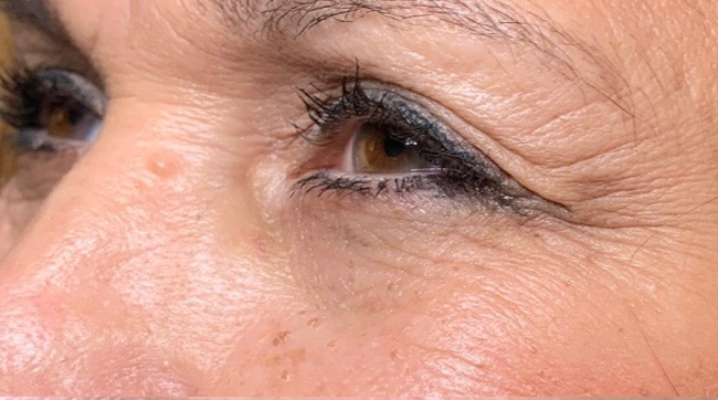 Wrinkle Relaxers Before and After - Case 7, Image 2 - Female, age 45 – 54 - East Moriches, NY - MD365 Aesthetics
