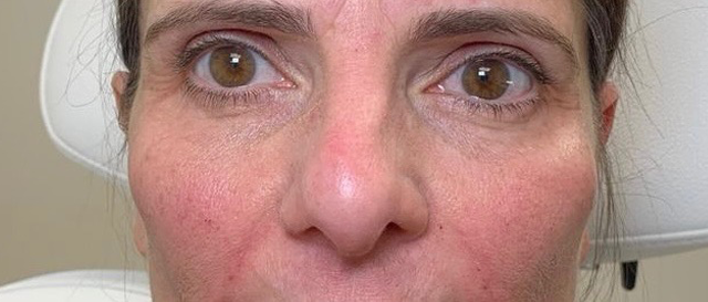Dermal Fillers Before and After - Case 11, Image 2 - Female, age 55 – 64 - East Moriches, NY - MD365 Aesthetics