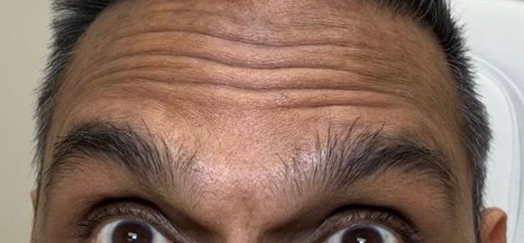 Wrinkle Relaxers Before and After - Case 8, Image 1 - Male, age 35 – 44 - East Moriches, NY - MD365 Aesthetics