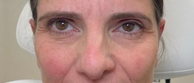 Dermal Fillers Before and After - Case 11, Image 1 - Female, age 55 – 64 - East Moriches, NY - MD365 Aesthetics