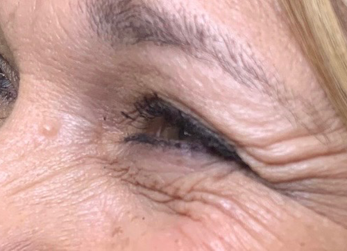 Wrinkle Relaxers Before and After - Case 7, Image 1 - Female, age 45 – 54 - East Moriches, NY - MD365 Aesthetics
