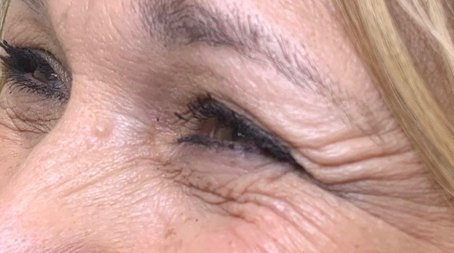 Wrinkle Relaxers Before and After - Case 7, Image 1 - Female, age 45 – 54 - East Moriches, NY - MD365 Aesthetics